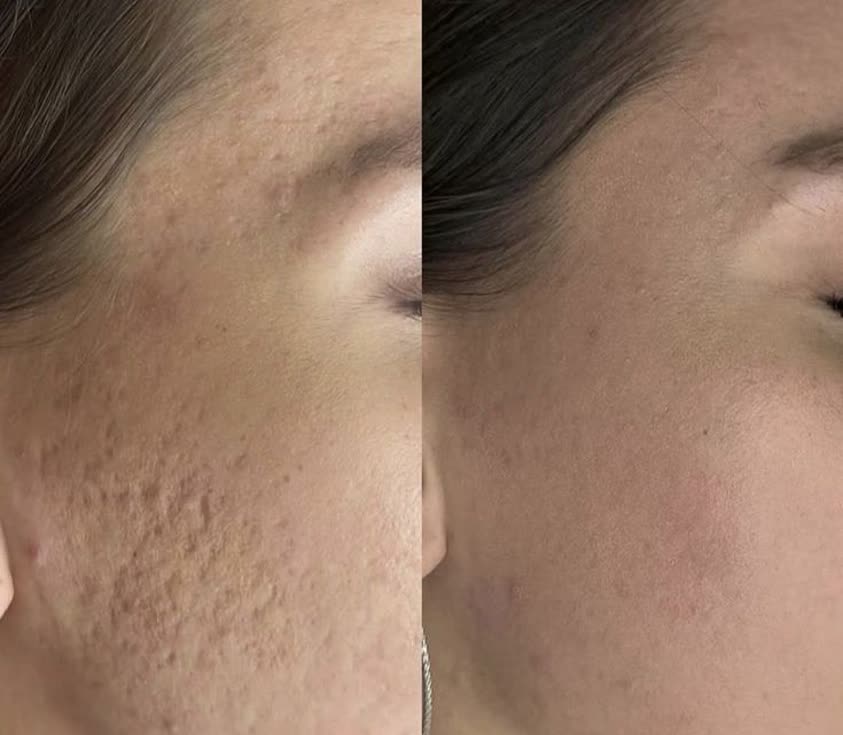 اثر لیزر CO₂ فرکشنال بر روی اسکار آکنه