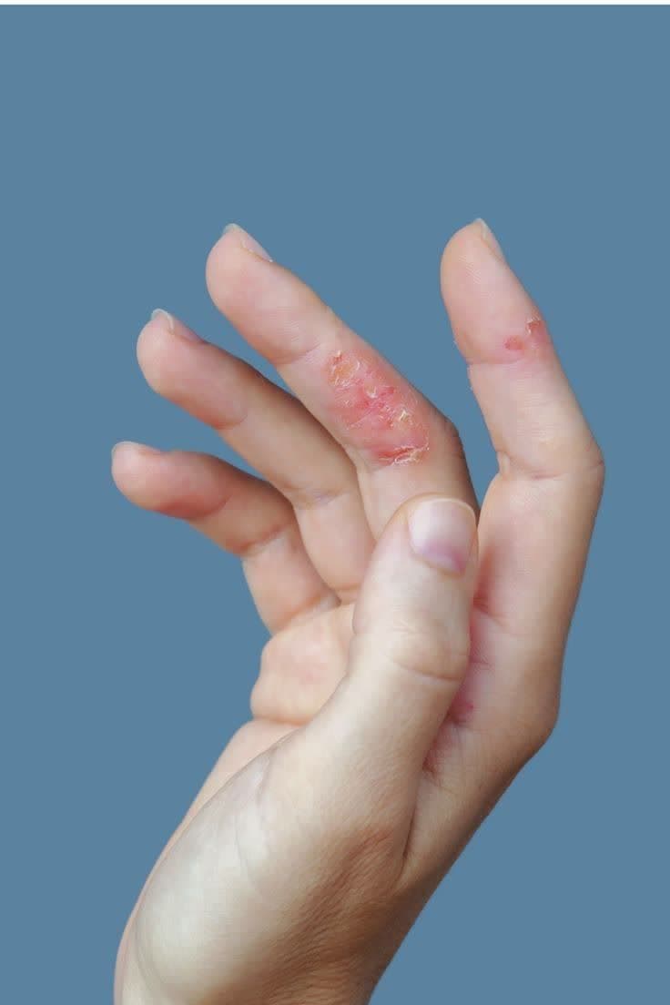 اگزما و راه های درمان آن