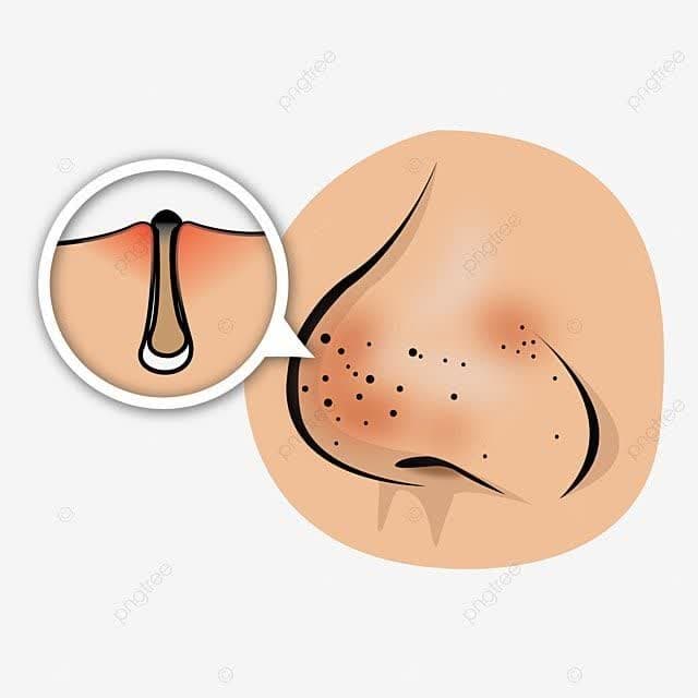 جوش های سر سیاه