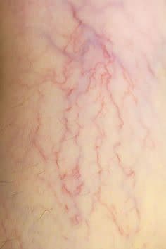 رفع تلانژکتازی