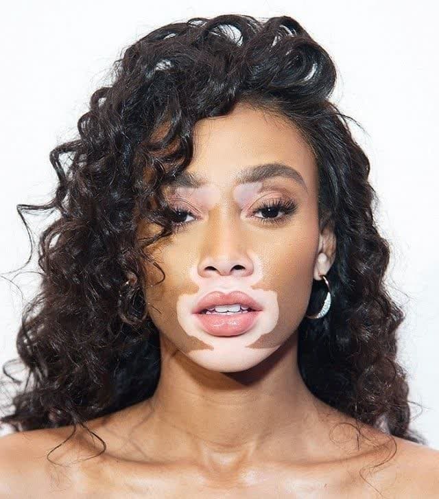 علت و درمان پیسی