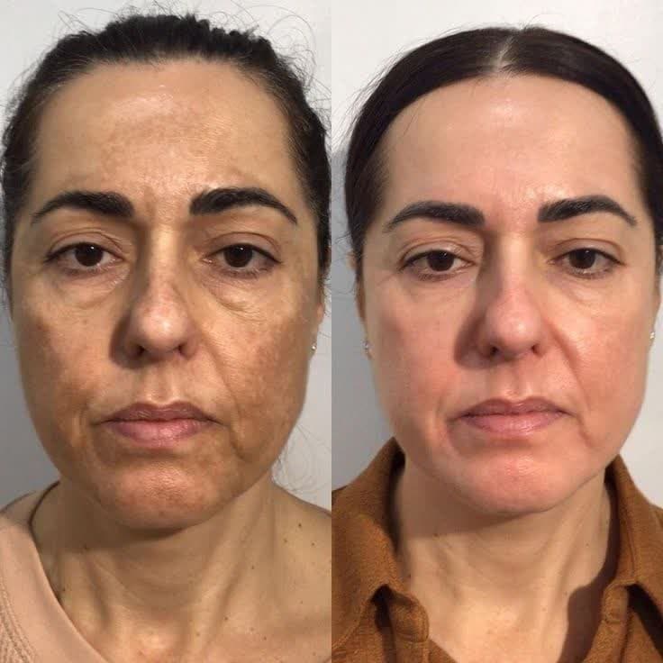 لیزر CO2 فرکشنال